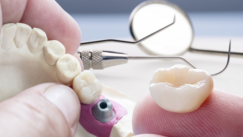 Fixed Partial Denture In Mohali