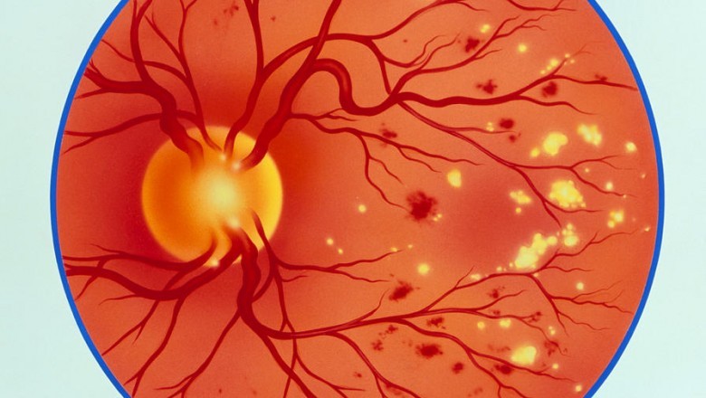 Impact of COVID-19 Pandemic On Diabetic Retinopathy Treatment Market | Growth By Top Company, Region, Applications, Drivers, Trends & Forecast to 2027 | CAGR of 11.9% | Ampio Pharmaceuticals (U.S.), Novartis AG (Germany)