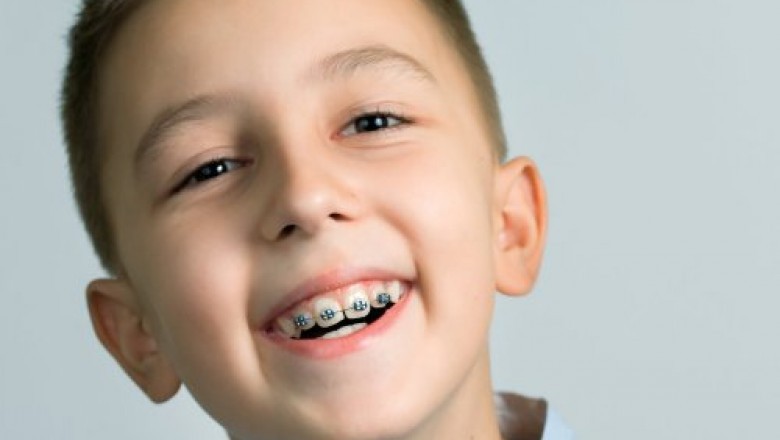 Incognito Hidden Braces