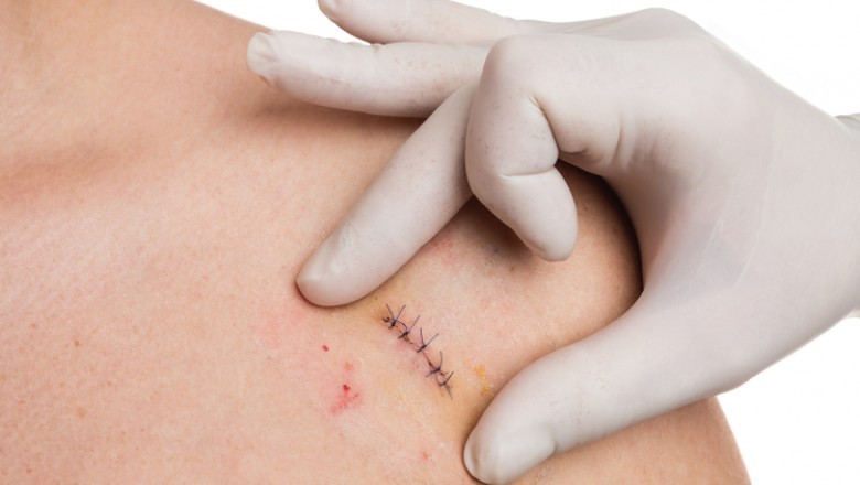 Skin Biopsy Market Growth, Trends, Demand, Industry Analysis, Key Player profile and Regional Outlook by 2027 | COOK Medical (U.S.), Devicor Medical Products, Inc. DTR Medical Ltd (U.K), Gallini Srl (Italy), Hologic, Inc.