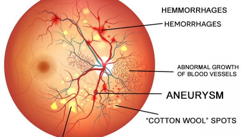 Diabetic Retinopathy Market Upcoming Trends, On-Going Demand, Growth and Forecast from 2021 to 2027 | Sirnaomics (U.S.), Actavis Plc (U.K.), Regeneron Pharmaceuticals Inc. (U.S.), ThromboGenics