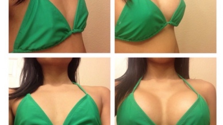 A Quick Overview of Breast Reduction