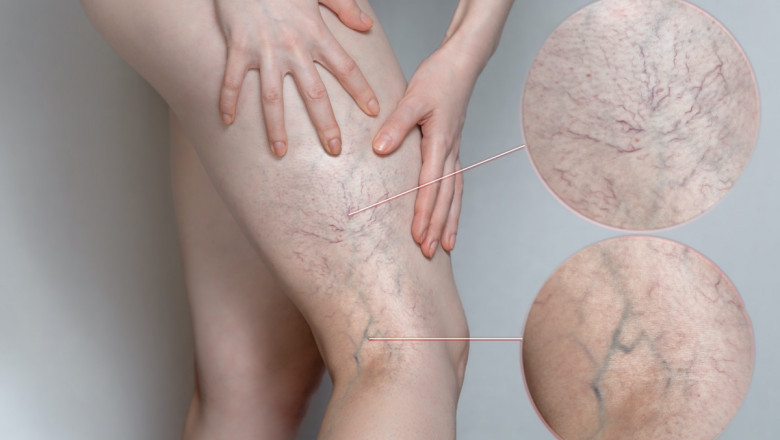 Why You Should Get Spider Vein Treatment ?