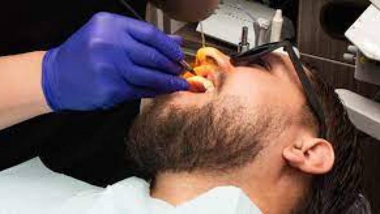 How Much Does a Root Canal Cost?