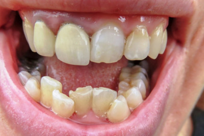 Why Wisdom Teeth Removal? Here are 3 Reasons!