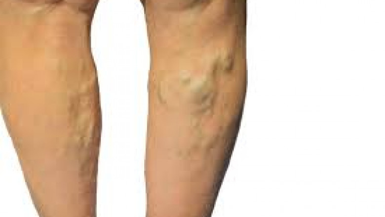 How Intense Pulsed Light Therapy Helps In Treating Veins?