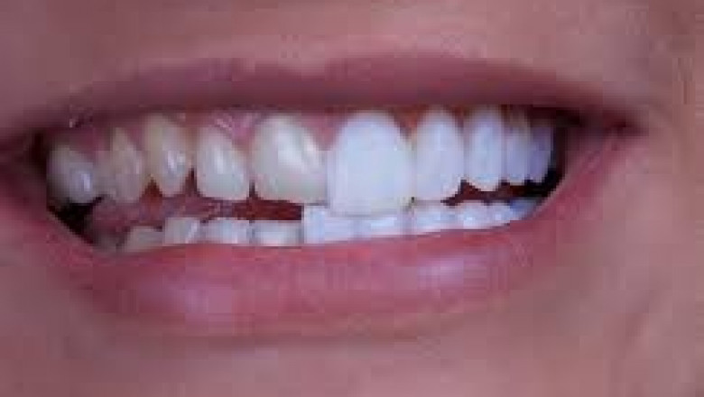 Porcelain Veneers Teeth