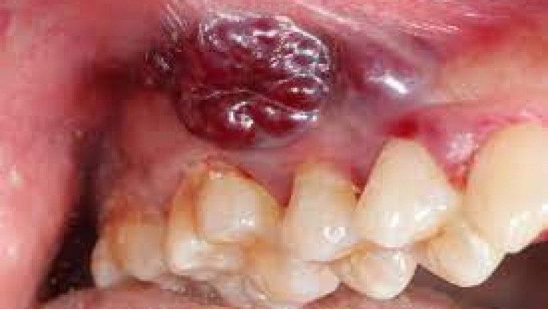 What is Oral Pathology?
