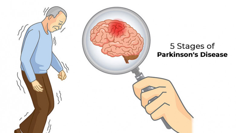 Advanced Parkinson's Disease - What Effects Of Parkinson's Disease