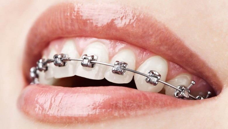 Clarity Clear Aligners