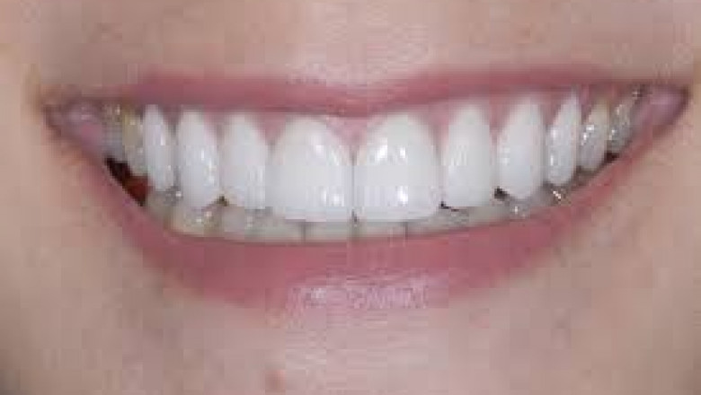 Tooth Replacement Vienna Va