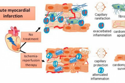 Ischemia Reperfusion Injury Therapeutics Market Sales Forecasts Reveal Positive Growth Through 2027