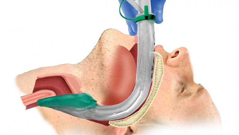 Airway Management Market Demand, Industry Analysis, Key Player profile, Regional Outlook and Comprehensive Research Analysis by 2027