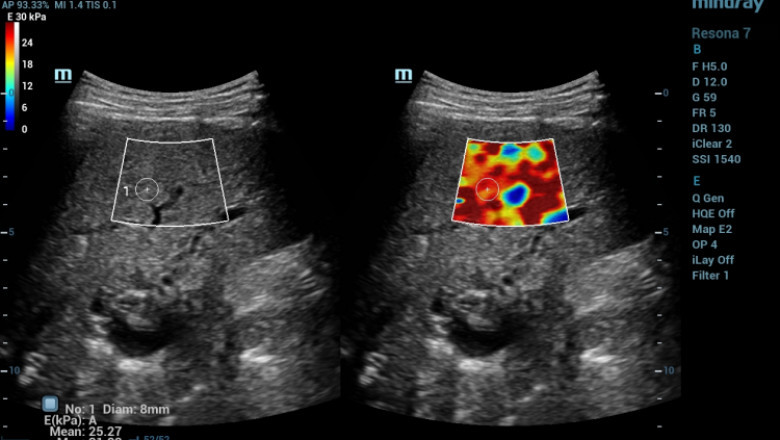 Elastography Imaging Market to Witness Increasing Product Launches Even During the Coronavirus Crises; MRFR Releases the Forecast for 2019-2027