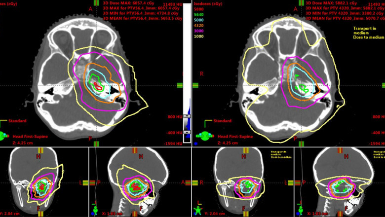 Intensity-Modulated Proton Therapy Market Forecast to 2028 - COVID-19 Impact and Global Analysis