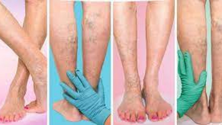 What causes spider veins on the face?