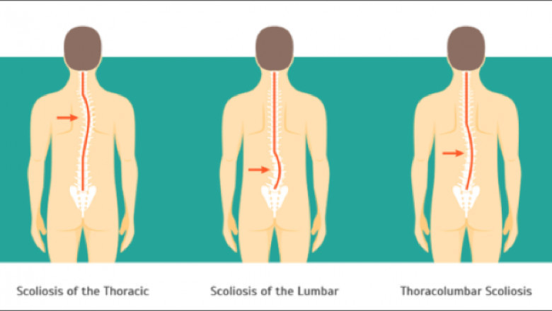 AYURVEDIC TREATMENTS FOR THORACOLUMBAR SCOLIOSIS