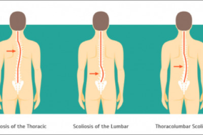 AYURVEDIC TREATMENTS FOR THORACOLUMBAR SCOLIOSIS