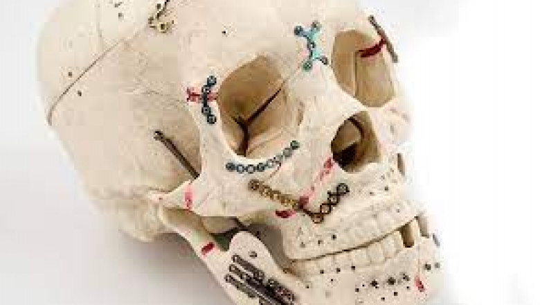 The Craniomaxillofacial Implants market, by application site, is segmented into external fixators and internal fixators