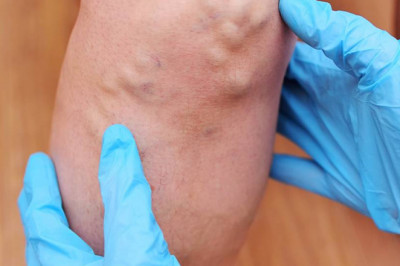 AYURVEDIC TREATMENT FOR DEEP VEIN THROMBOSIS (DVT)