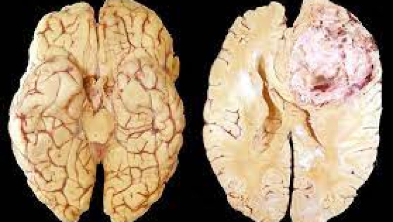 Products related with surgery are in high demand in the Recurrent Glioblastoma Multiforme Treatment Market.
