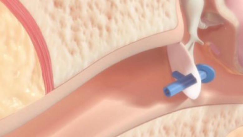 The aforementioned factors are also expected to accelerate the growth of the Tympanostomy Products Market