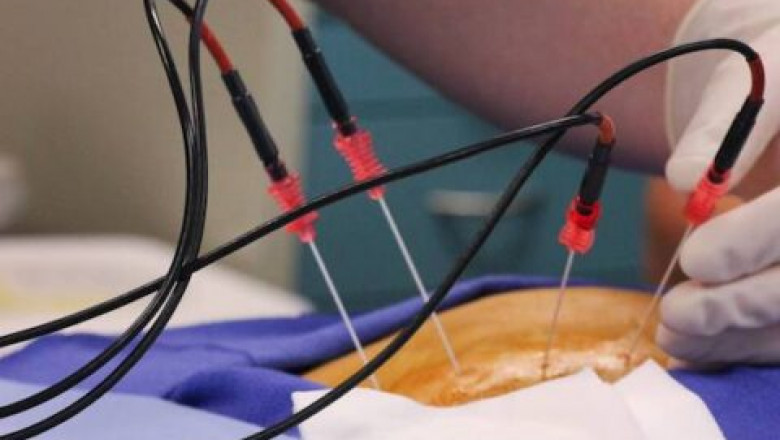 The demand for ablation devices is also increasing, driving the Radiofrequency Ablation Devices Market