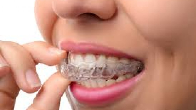 What are Dentures And How to Take Care of Them?