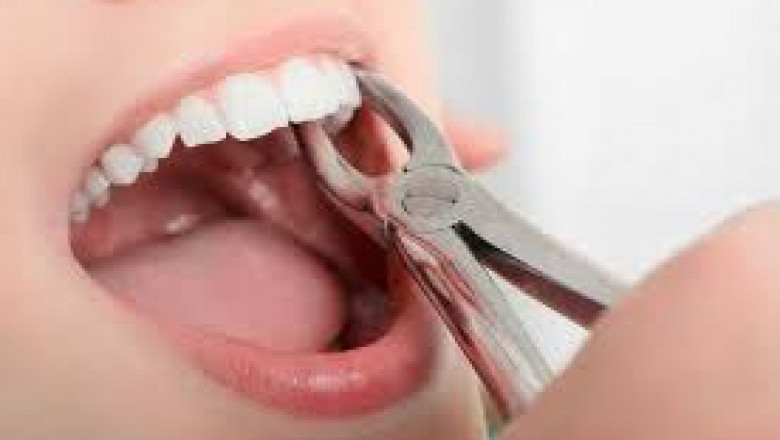 Tooth Extraction: What Are The Different Types?