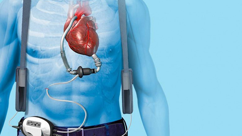 Cardiac Assist Devices: Highly efficient: Portable: and offer 100% Success