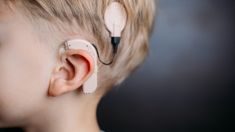 Cochlear Implants: Tiny Electronic Devices Stimulate Cochlear Nerve for Effective Management of Hearing Loss