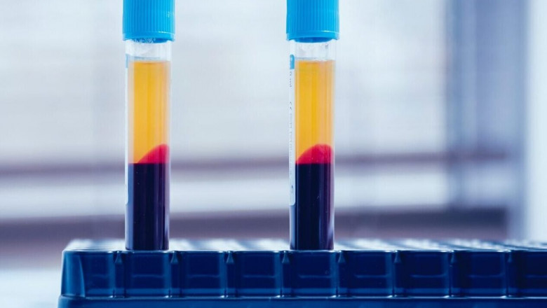 One of the advantages of Platelet rich plasma (PRP) is that it can be used to relieve pain during COVID-19
