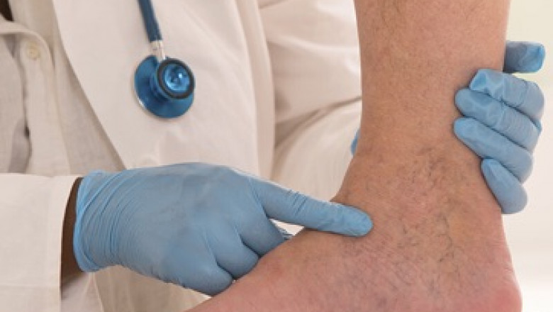 What Are The Different Types Of Vein Diseases?
