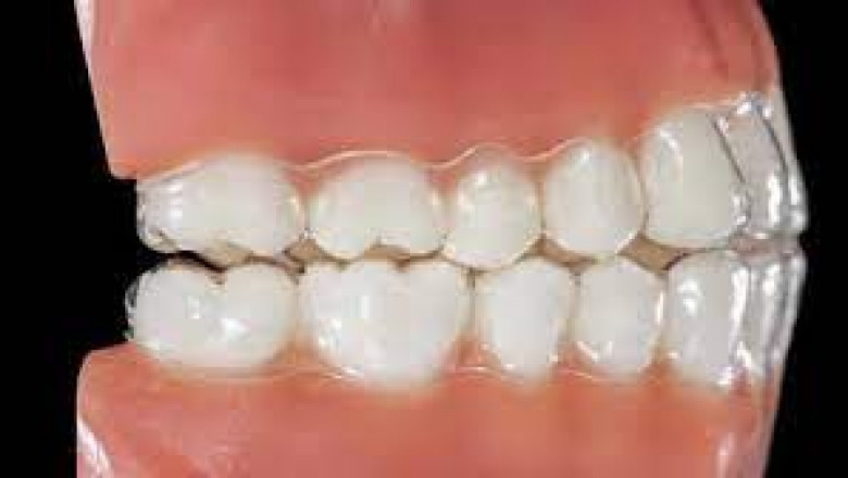 What are the Reasons and Advantages of Root Canal Therapy?