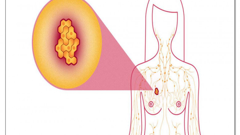 NATURAL TREATMENT OF BREAST CANCER