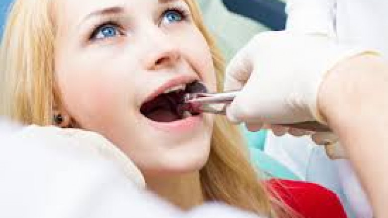 Reasons Why Wisdom Tooth Extraction Is Mandatory