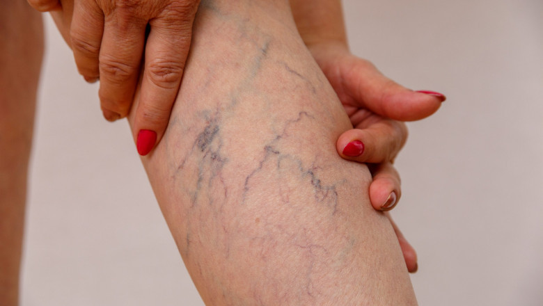 What to do if the varicose vein is bleeding?