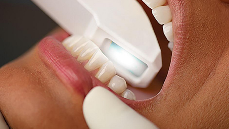 There are two different types of Digital Impression System.