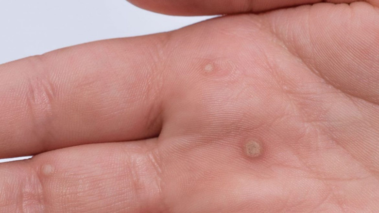 Acute Bacterial Skin and Skin Structure Infections (ABSSSI) are bacterial infections that cause a large abnormal patch of tissue to develop around wounds