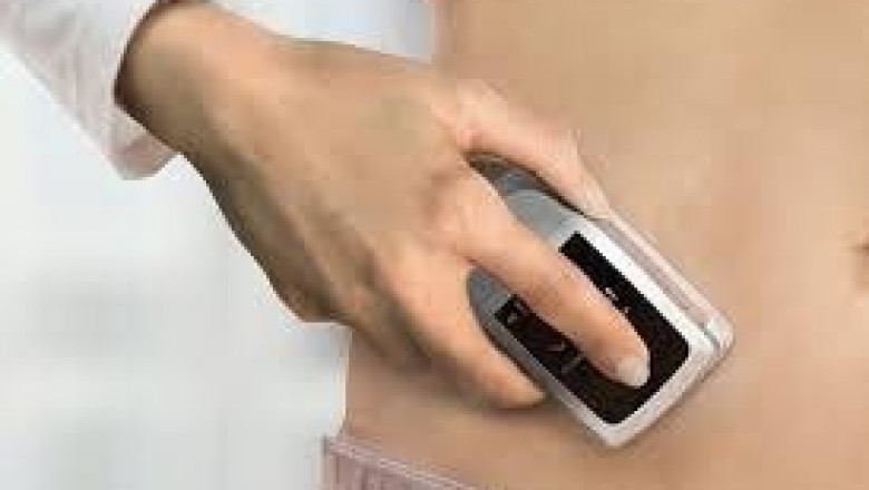 An innovative subcutaneous drug delivery system called Wearable Injector