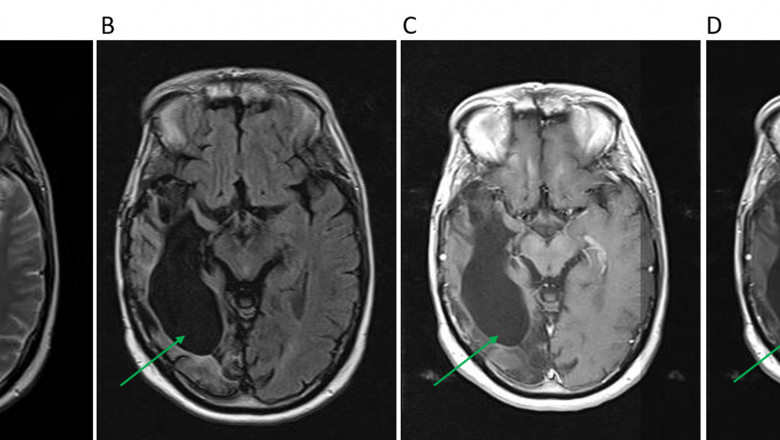 Recurrent Glioblastoma Multiforme Treatment involved Glial cells, which is a type of brain cancer