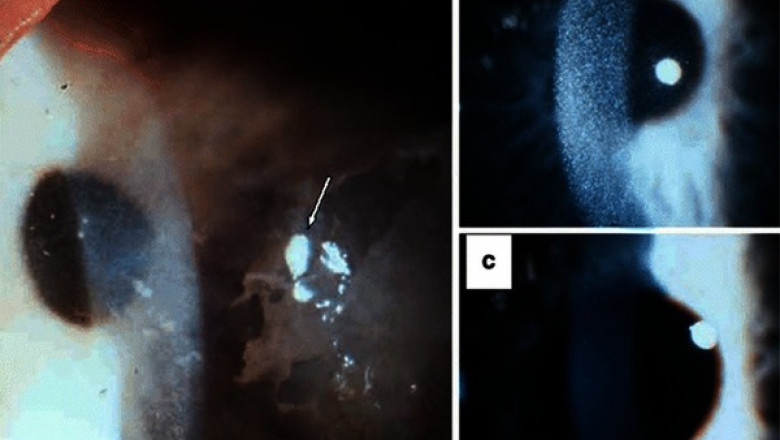 Cystinosis treatment varies dependent on the patient's age, type, and severity of the disease.