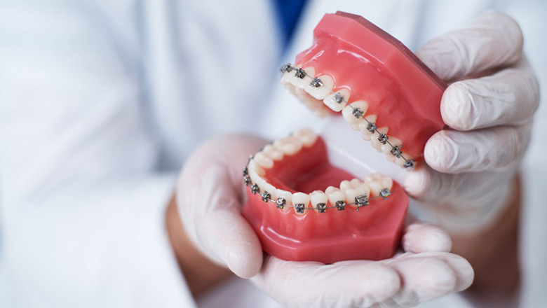 What are the Essential Tips to Optimize the Invisalign Treatmen