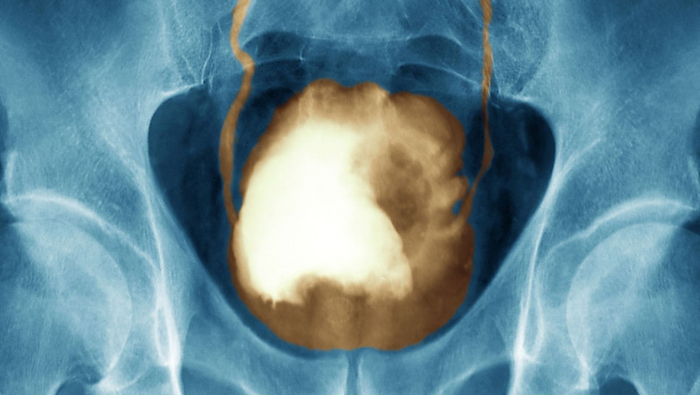 Bladder Cancer 2021- Challenges, Key Players, Industry Segments, Development, Opportunities, Forecast Report, Demand, Size, Share 2027