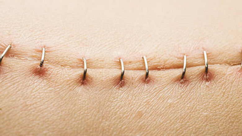 Surgical Stapler Market Trends, Segmentation, Growth, SWOT Analysis, Opportunities And Forecast To 2027