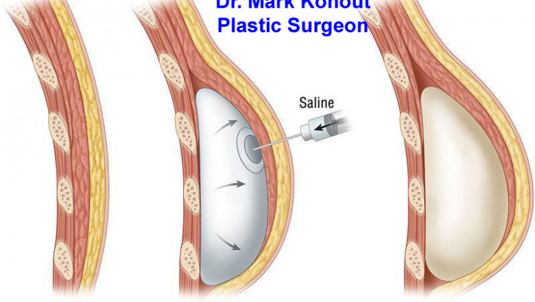 Breast Implant Replacement Surgery
