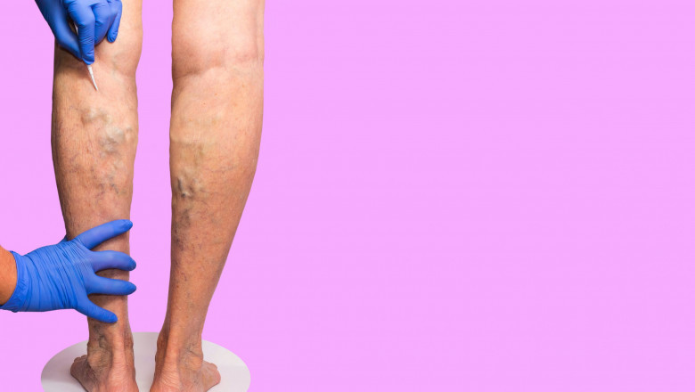 Vein Treatment: How To Eliminate Spider Veins?
