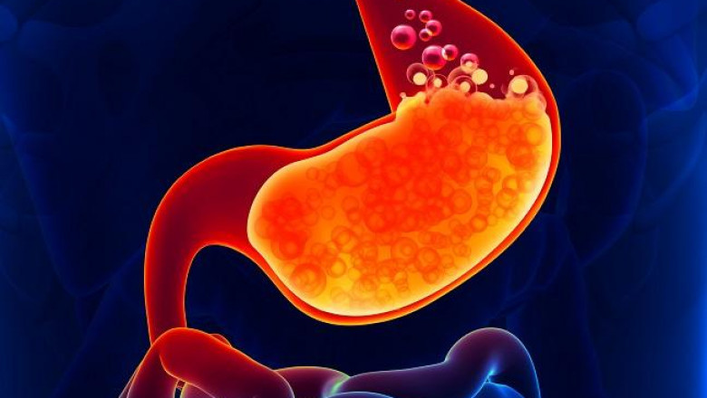 Proton Pump Inhibitors are drugs that block the production of protons in the body. Reduce Stomach Acid to Treat Stomach and Esophagus Issues