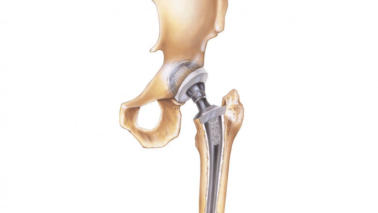 The major benefit of Bone Replacement Products is that they can be used for bony areas where the natural growth pattern is missing