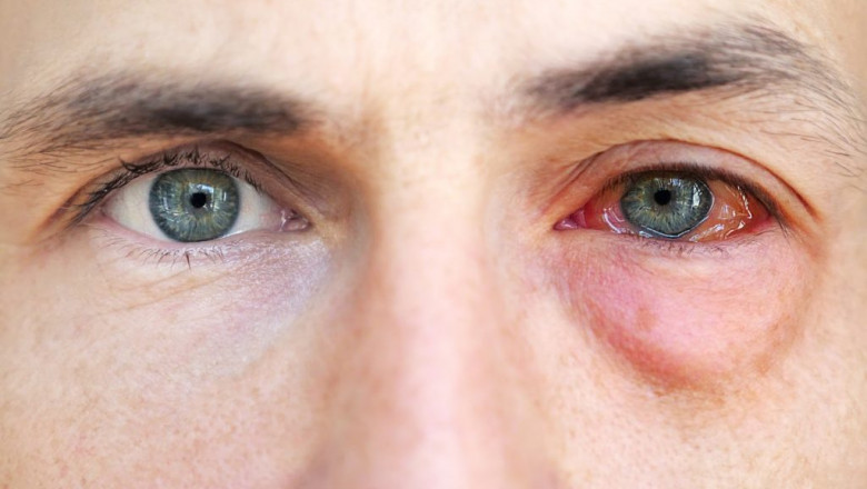 Oral antihistamines, such as loratadine, fexofenadine, and cetirizine, are commonly used to treat Allergic Conjunctivitis.